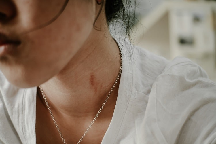 How can I cover up a hickey without makeup?