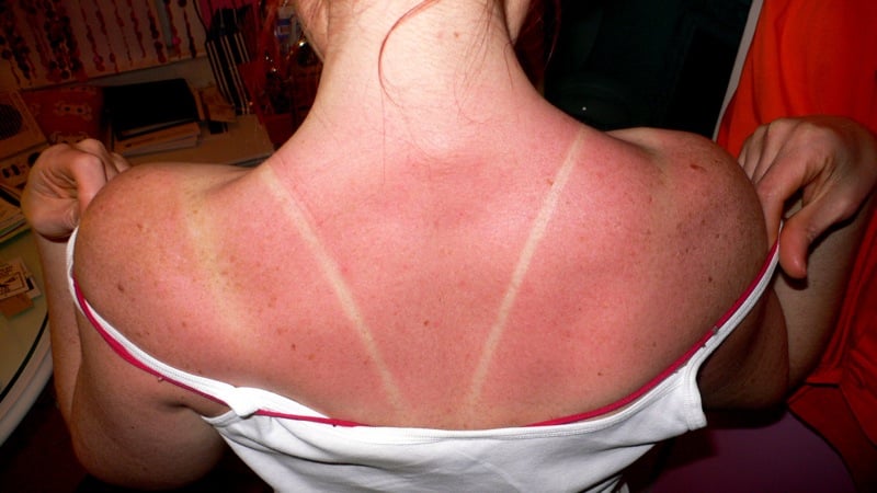 woman with a red sunburned skin